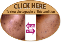 CLICK HERE to view photographs of this condition