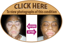 CLICK HERE to view photographs of this condition